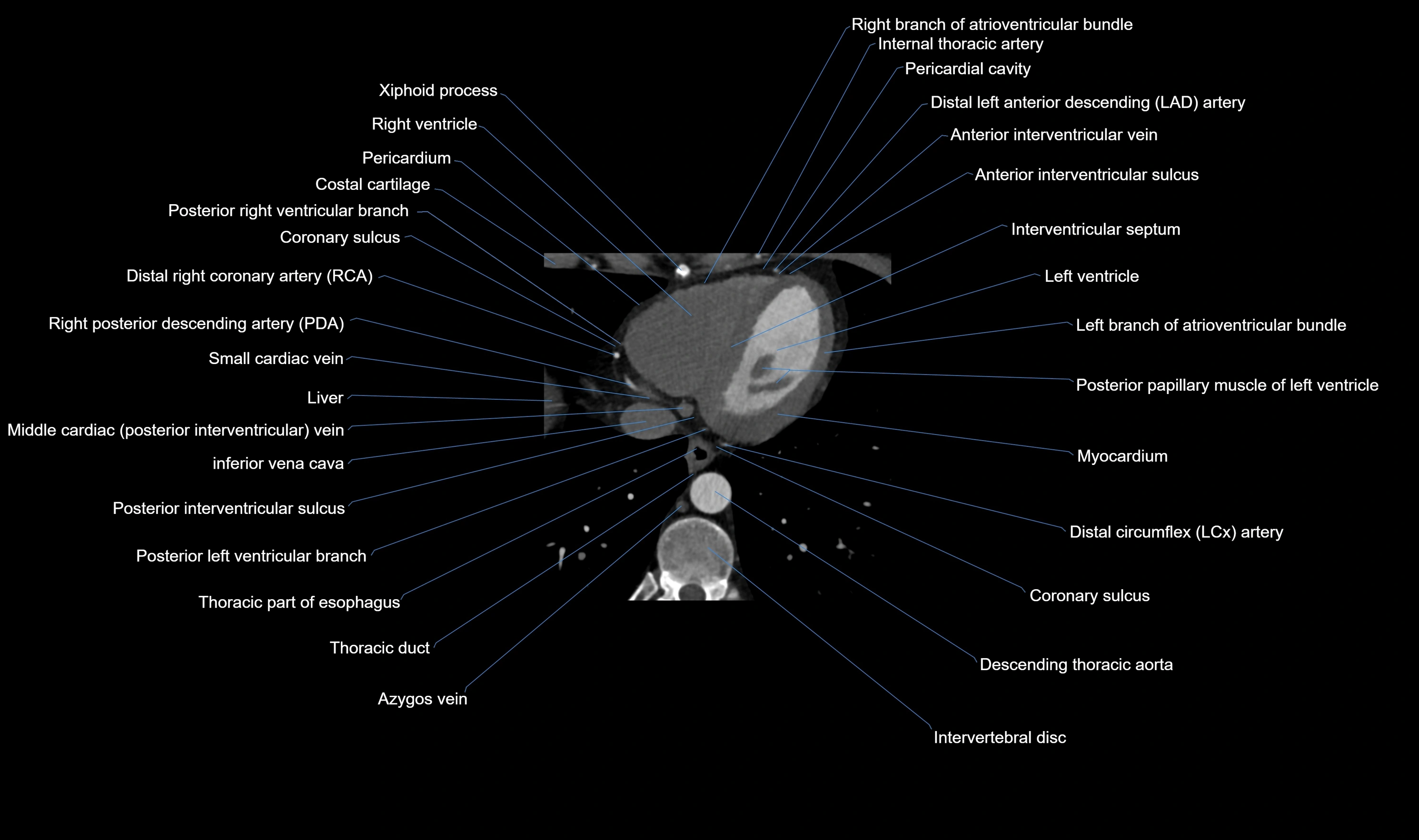 CT heart (coronary angiogram) axial view cross sectional anatomy labelled radiology image-00056.webp